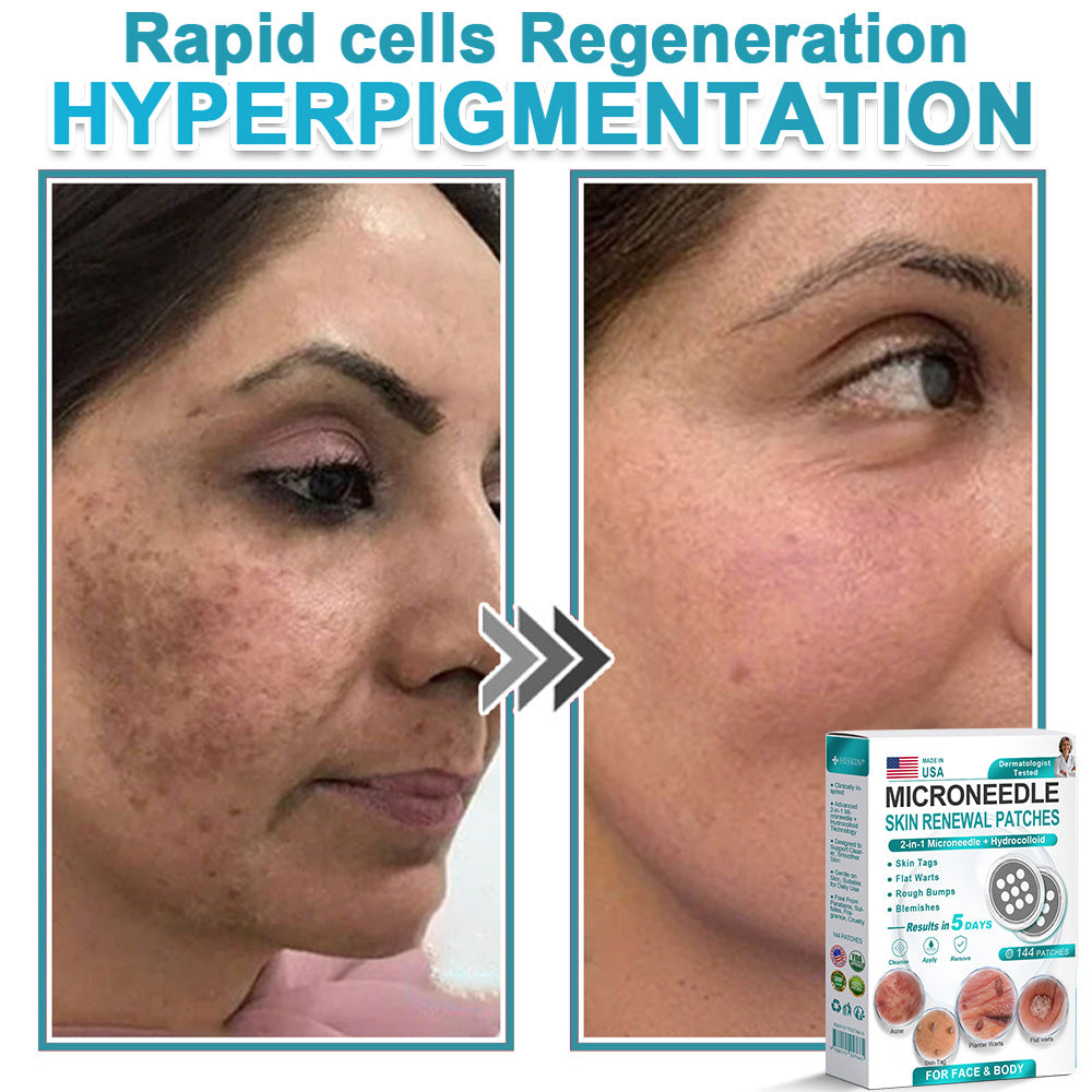 Careerel ® 2-in-1 Microneedle & Hydrocolloid Patch👨‍⚕️ | Removes raised moles, acne, flat warts, and skin tags | Helps improve wrinkles, scars, and blemishes | Invisible patches for face and body💖