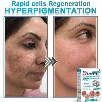 Careerel ® 2-in-1 Microneedle & Hydrocolloid Patch👨‍⚕️ | Removes raised moles, acne, flat warts, and skin tags | Helps improve wrinkles, scars, and blemishes | Invisible patches for face and body💖