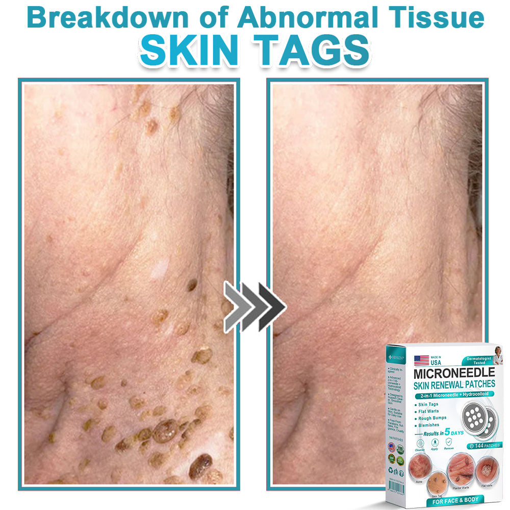 Careerel ® 2-in-1 Microneedle & Hydrocolloid Patch👨‍⚕️ | Removes raised moles, acne, flat warts, and skin tags | Helps improve wrinkles, scars, and blemishes | Invisible patches for face and body💖