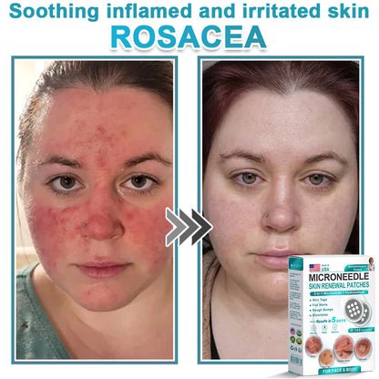 Careerel ® 2-in-1 Microneedle & Hydrocolloid Patch👨‍⚕️ | Removes raised moles, acne, flat warts, and skin tags | Helps improve wrinkles, scars, and blemishes | Invisible patches for face and body💖