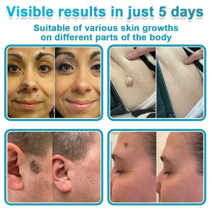 Careerel ® 2-in-1 Microneedle & Hydrocolloid Patch👨‍⚕️ | Removes raised moles, acne, flat warts, and skin tags | Helps improve wrinkles, scars, and blemishes | Invisible patches for face and body💖
