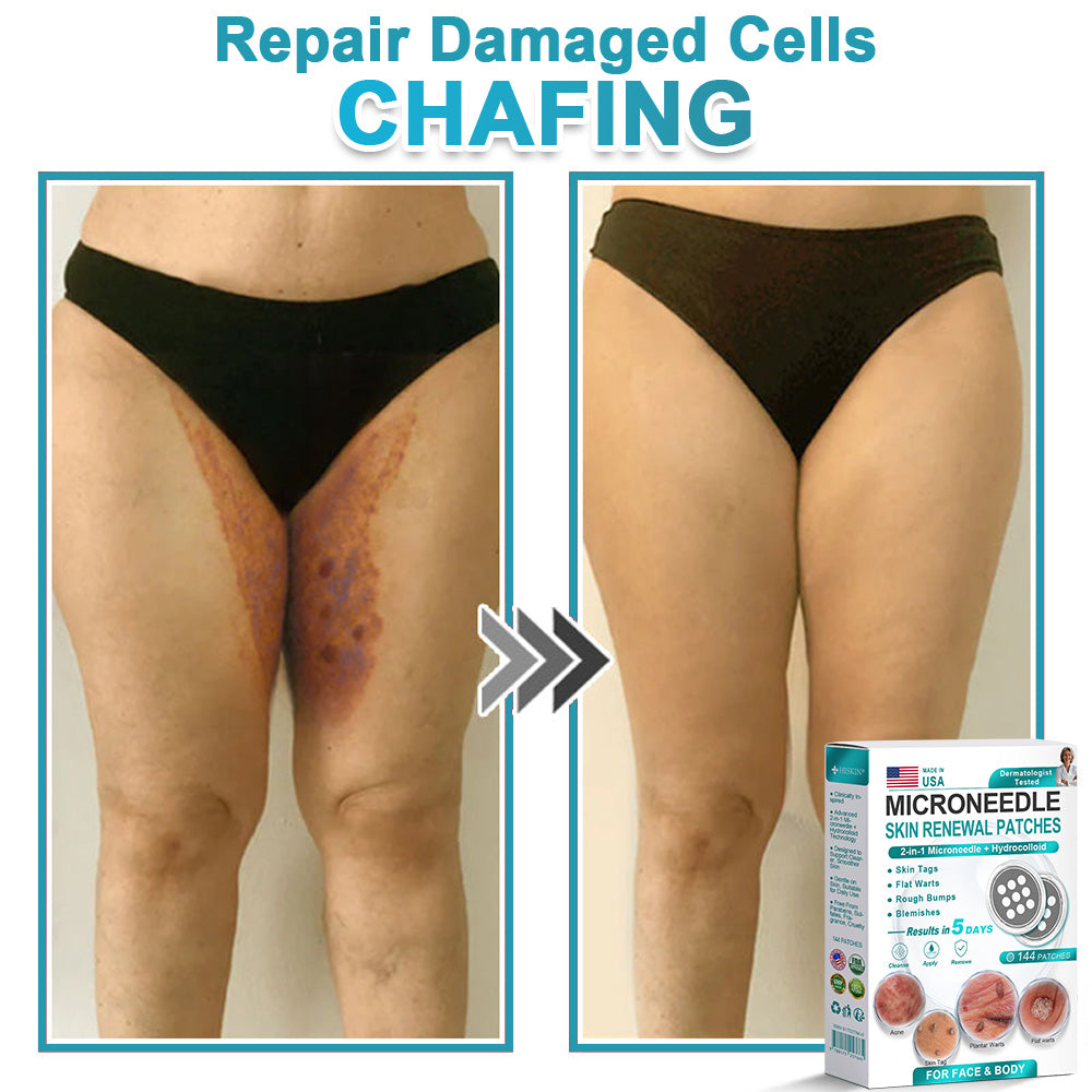 Careerel ® 2-in-1 Microneedle & Hydrocolloid Patch👨‍⚕️ | Removes raised moles, acne, flat warts, and skin tags | Helps improve wrinkles, scars, and blemishes | Invisible patches for face and body💖