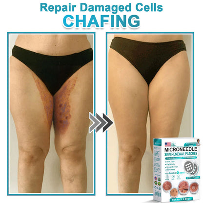 Careerel ® 2-in-1 Microneedle & Hydrocolloid Patch👨‍⚕️ | Removes raised moles, acne, flat warts, and skin tags | Helps improve wrinkles, scars, and blemishes | Invisible patches for face and body💖