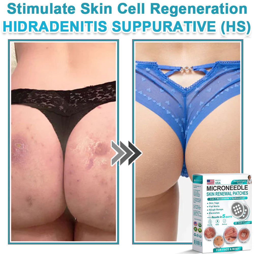 Careerel ® 2-in-1 Microneedle & Hydrocolloid Patch👨‍⚕️ | Removes raised moles, acne, flat warts, and skin tags | Helps improve wrinkles, scars, and blemishes | Invisible patches for face and body💖