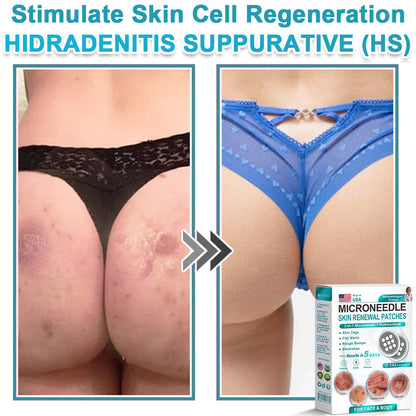 Careerel ® 2-in-1 Microneedle & Hydrocolloid Patch👨‍⚕️ | Removes raised moles, acne, flat warts, and skin tags | Helps improve wrinkles, scars, and blemishes | Invisible patches for face and body💖