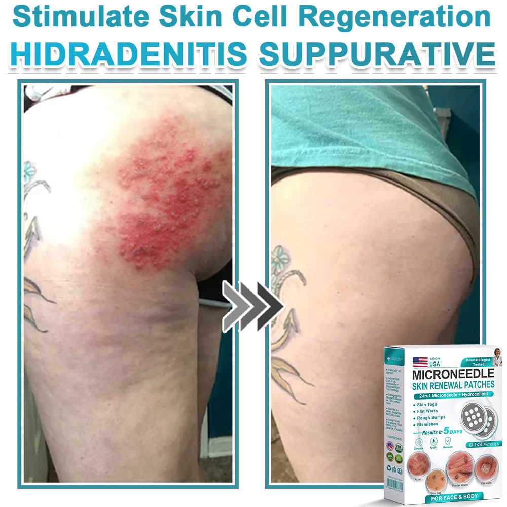 Careerel ® 2-in-1 Microneedle & Hydrocolloid Patch👨‍⚕️ | Removes raised moles, acne, flat warts, and skin tags | Helps improve wrinkles, scars, and blemishes | Invisible patches for face and body💖