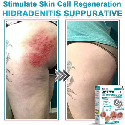 Careerel ® 2-in-1 Microneedle & Hydrocolloid Patch👨‍⚕️ | Removes raised moles, acne, flat warts, and skin tags | Helps improve wrinkles, scars, and blemishes | Invisible patches for face and body💖