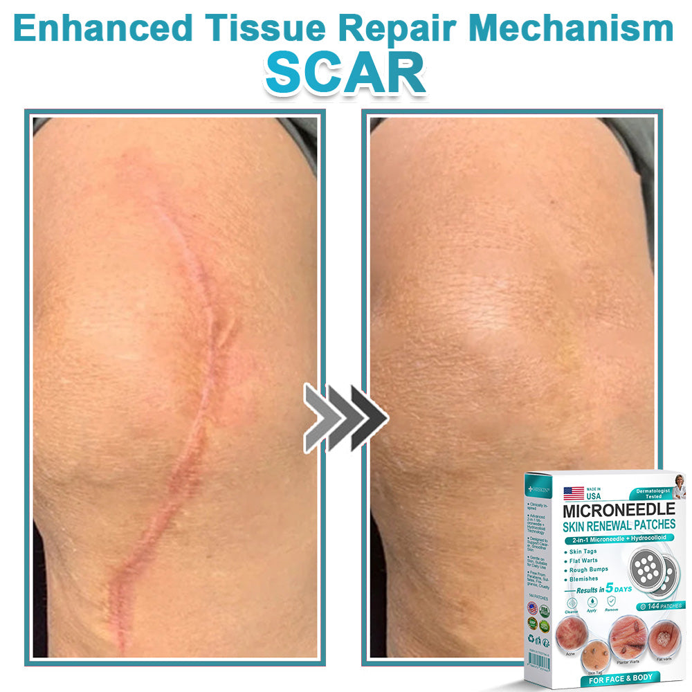 Careerel ® 2-in-1 Microneedle & Hydrocolloid Patch👨‍⚕️ | Removes raised moles, acne, flat warts, and skin tags | Helps improve wrinkles, scars, and blemishes | Invisible patches for face and body💖